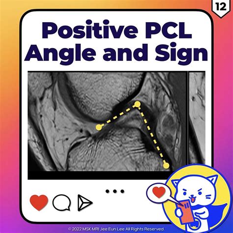 positive pcl sign